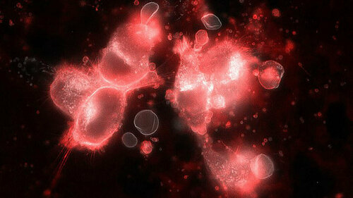 Melanoma cells surrounded by shed extracellular vesicles.  Image credit: Alanna Sedgwick, D'Souza-Schorey Laboratory