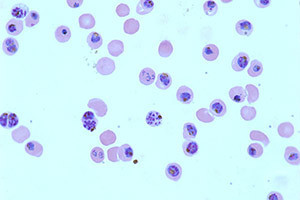 Pfalciparum Malaria