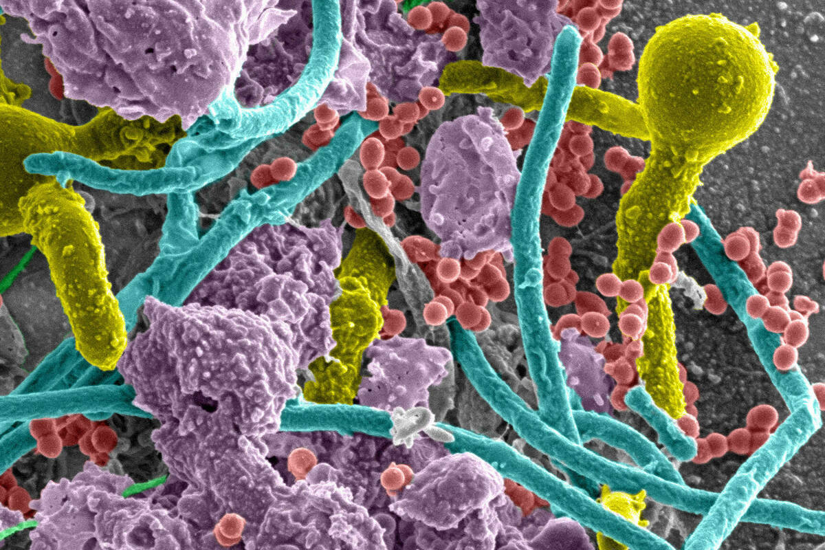 A zoomed in, microscopic image of a polymicrobial infection in a catheterized bladder showing the colors gold, teal, red, purple and green.