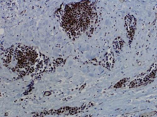 Invasive lobular mammary carcinoma immuno-stained for NOTCH4.  The NOTCH4 gene was one of 11 genes that were more frequently mutated in breast cancers from Native American women. Image shows nuclear localization of NOTCH4 (brown stain), indicative of active Notch signaling.  The Notch signaling pathway is associated with maintenance of cancer stem cells that can lead to therapy resistance and disease recurrence.